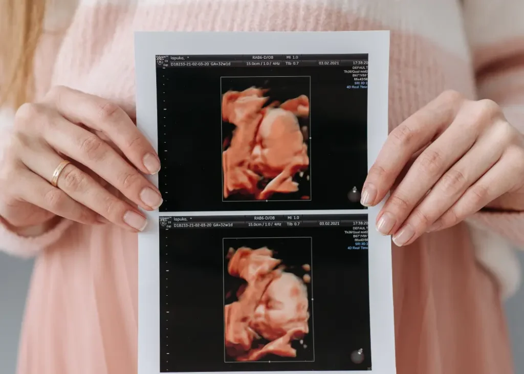 Woman holding ultrasound and pregnant after bariatric surgery