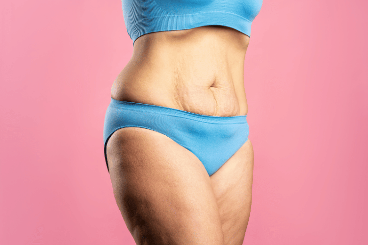 Excess Skin Post Bariatric Surgery