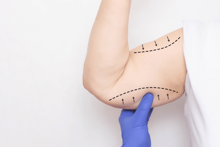 Arm Lift Surgical Option for Excess Skin Removal